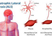 Telbivudine : A drug typically used to treat hepatitis could slow the progression of ALS