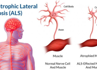 Telbivudine : A drug typically used to treat hepatitis could slow the progression of ALS