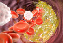 A group of genes that has been largely ignored by scientists could play critical roles in atherosclerosis