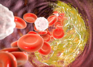 A group of genes that has been largely ignored by scientists could play critical roles in atherosclerosis
