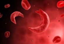 A daily hydroxyurea pill may finally bring some relief for young children living with the painful and deadly blood disease sickle cell anemia (SCA)