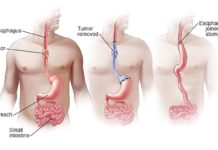 A change in the genome of Caucasians could explain much-higher rates of the most common type of esophageal cancer