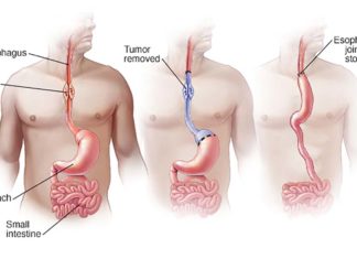 A change in the genome of Caucasians could explain much-higher rates of the most common type of esophageal cancer