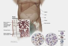 Patients with chronic lymphocytic leukemia treated with Ibrutinib have a significantly lower rate of disease progression