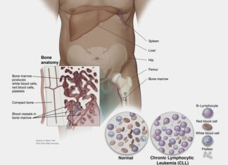 Patients with chronic lymphocytic leukemia treated with Ibrutinib have a significantly lower rate of disease progression