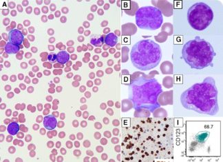 Elzonris (tagraxofusp-erzs) infusion was granted the first approval for the treatment of blastic plasmacytoid dendritic cell neoplasm (BPDCN)