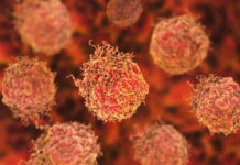 Research investigating the benefits of surgery for prostate cancer