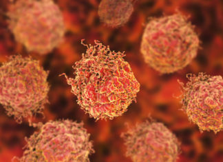 Research investigating the benefits of surgery for prostate cancer