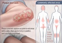 Psoriasis : Scientists have discovered a protein that could hold the key to novel gene therapies