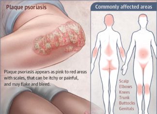 Psoriasis : Scientists have discovered a protein that could hold the key to novel gene therapies
