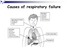 Children with life-threatening respiratory failure who require mechanical ventilation in a pediatric intensive care unit commonly experience rapid muscle atrophy
