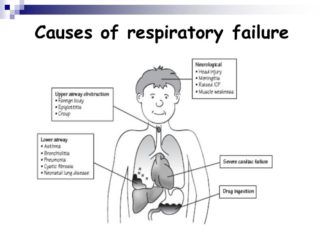 Children with life-threatening respiratory failure who require mechanical ventilation in a pediatric intensive care unit commonly experience rapid muscle atrophy
