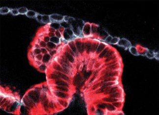 A new technique to study tissue samples in 3-D has revealed that pancreatic cancers can start and grow in two distinct ways