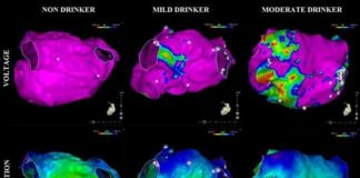 Atrial fibrillation – Even moderate alcohol consumption is a risk factor