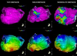 Atrial fibrillation – Even moderate alcohol consumption is a risk factor
