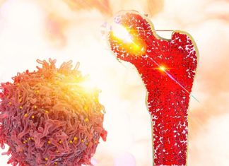 Bone marrow transplant (BMT) offers patients with leukemia and lymphoma a potentially curative treatment