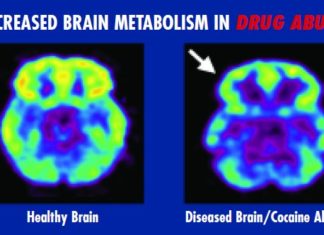 Brain scan data could correctly predict who will remain drug-free
