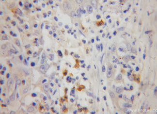 Glioblastoma : FGL2 protein can eliminate tumor progression