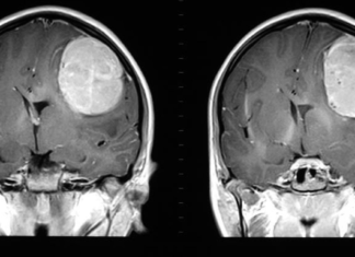 Glioblastoma brain cancer – Researchers report our gender can determine longevity and response to treatment