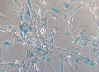 Leukaemia promotes premature ageing in healthy bone marrow cells