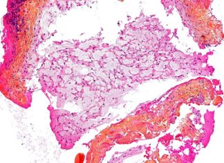 New hope for Chordoma cancer