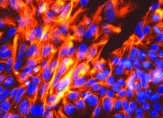 Treating diabetes : New hope from stem cell