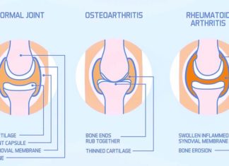 Osteoarthritis : possible new routes to treating the disease