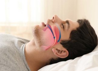 People with sleep apnea struggle to remember details of memories from their own lives
