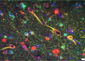 Porphyromonas gingivalis : Bacterial pathogen may contribute to Alzheimer’s disease