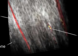 Researchers has discovered a new type of blood vessel in the bones