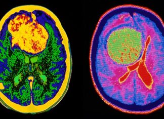 Researchers has identified distinct molecular signatures of glioblastoma in men and women
