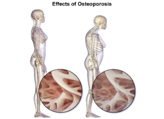 Researchers have crated a new atlas of genetic influences on osteoporosis