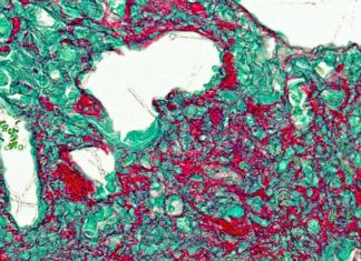 Researchers have found new treatment for Idiopathic pulmonary fibrosis (IPF)