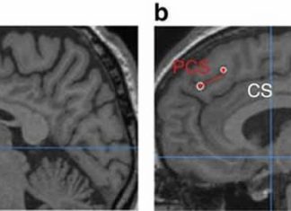 Researchers implicate a brain region called the paracingulate sulcus in the experience of hallucinations