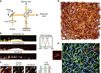 SC-OCTA : the 3-D-imaging technique that detect subtle changes in capillary organization