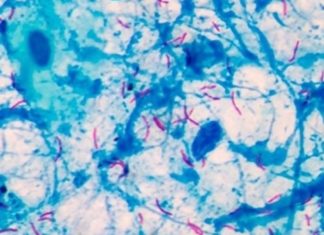 Tuberculosis (TB): new second generation rapid blood test