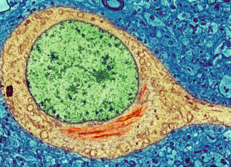 Alzheimer disease : identified racial disparities