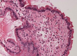 New research has found a link between the change in amyloid levels and Alzheimer’s disease.
