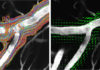Association between high blood pressure and Alzheimer’ disease