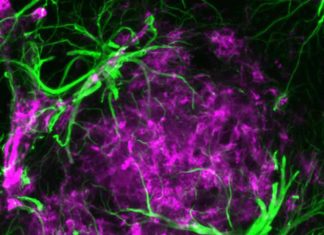 Defective astrocytes are linked to the buildup of a toxic protein that is the hallmark of Parkinson’s disease