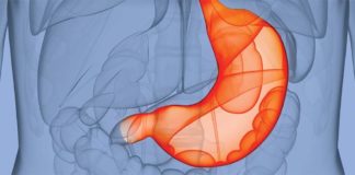 Bariatric surgery : Israeli startup develops Endozip device to stitch up stomach bulge