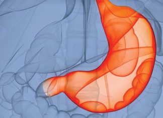 Bariatric surgery : Israeli startup develops Endozip device to stitch up stomach bulge