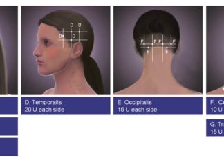 Botulinum toxin (Botox) injections can help to reduce the frequency of chronic migraines