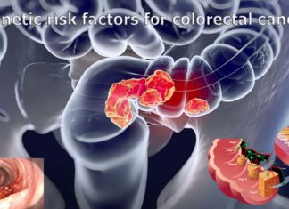Researchers have identified unknown and multiple genetic risk factors for colorectal cancer