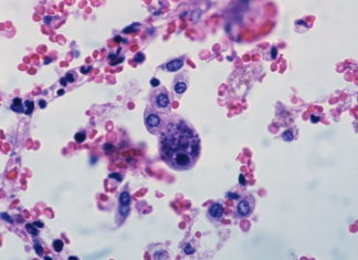 Researchers learn how common virus reactivates after transplantation