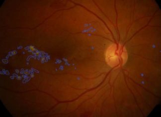 AI can instantly diagnos one of the top causes of blindness, diabetes-related eye disease