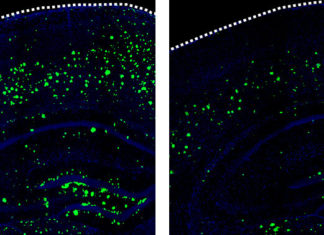 Drug developed to treat stroke patients could prevent Alzheimer’s disease