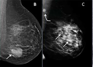 Research has found that the overgrowth of connective may block the effectiveness of immunotherapies against metastatic breast cancer