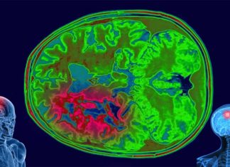 Defeating glioblastoma : microRNAs play an important role in cancer