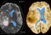A study reveals details of a way the dangerous glioblastomas resist the effects of antiangiogenic drugs